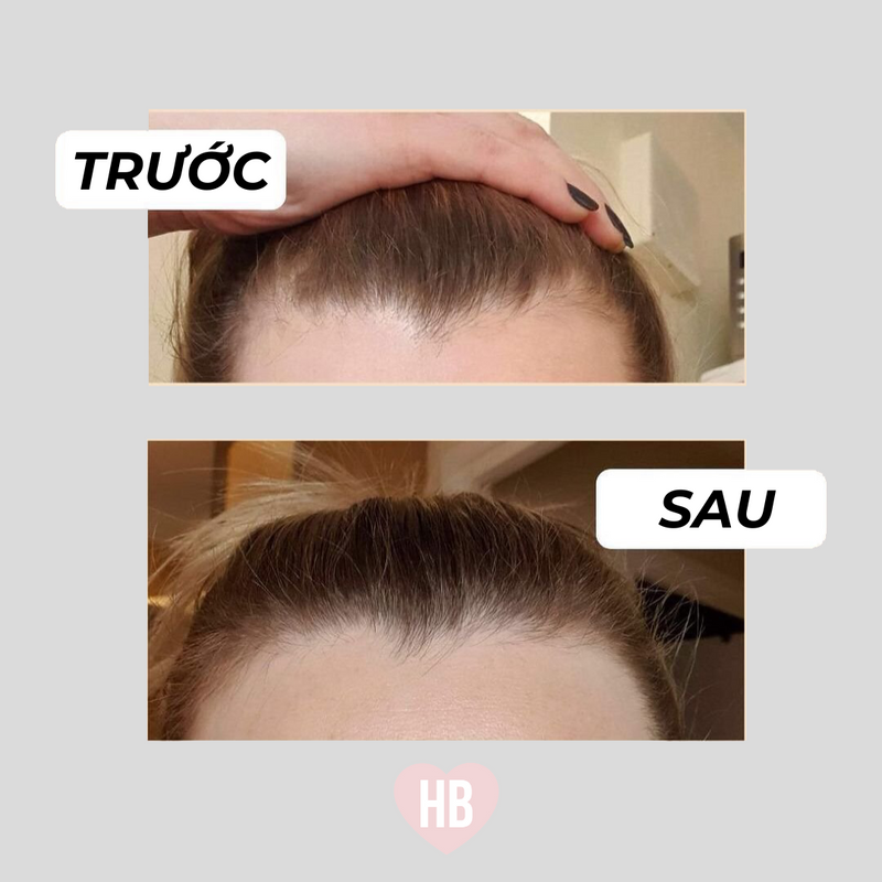 Chu trình Kẹo Dẻo Hairburst 3 Tháng Giúp Tóc Mọc Dài Nhanh Gấp Đôi