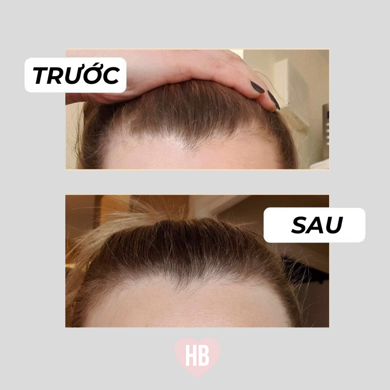 Combo Kẹo Dẻo Và Xịt Dưỡng Hairburst